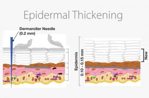 epidermal-thicking